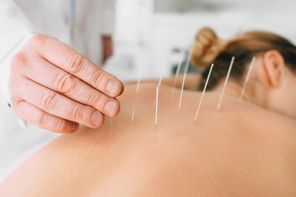 How Acupuncture Helps Substance Abuse Recovery